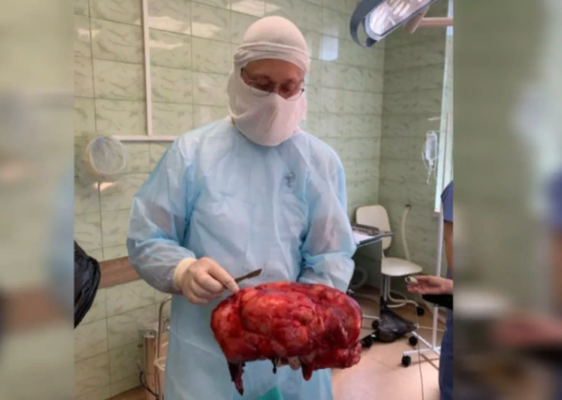 6-килограммовую опухоль удалили хирурги из живота пациента в Сочи